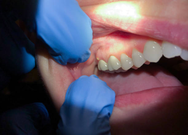 Best Knocked-Out Tooth (Avulsed Tooth) Treatment in Lyons, IL